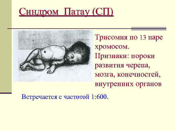 Синдром Патау (СП) Трисомия по 13 паре хромосом. Признаки: пороки развития черепа, мозга, конечностей,