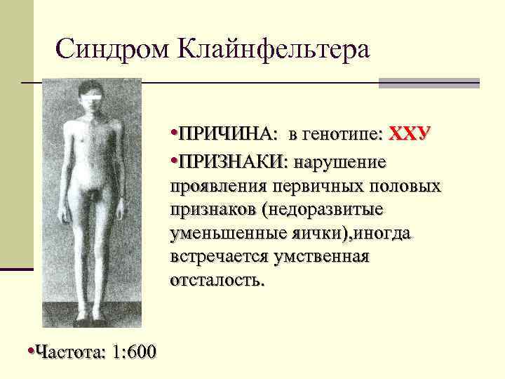 Синдром Клайнфельтера • ПРИЧИНА: в генотипе: ХХУ • ПРИЗНАКИ: нарушение проявления первичных половых признаков