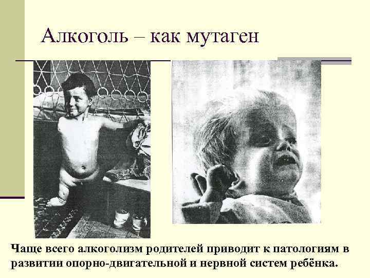 Алкоголь – как мутаген Чаще всего алкоголизм родителей приводит к патологиям в развитии опорно-двигательной