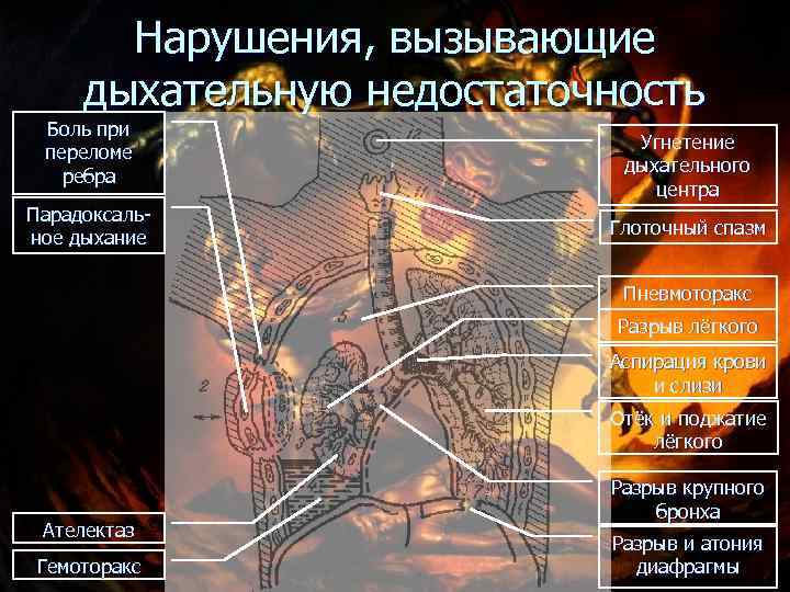  Нарушения, вызывающие дыхательную недостаточность Боль при Угнетение переломе дыхательного ребра центра Парадоксаль- Глоточный