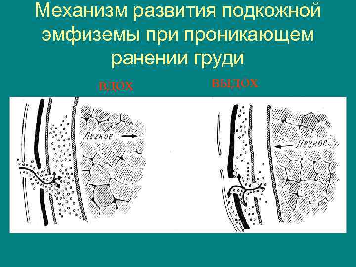 Механизм развития подкожной эмфиземы при проникающем ранении груди вдох выдох 