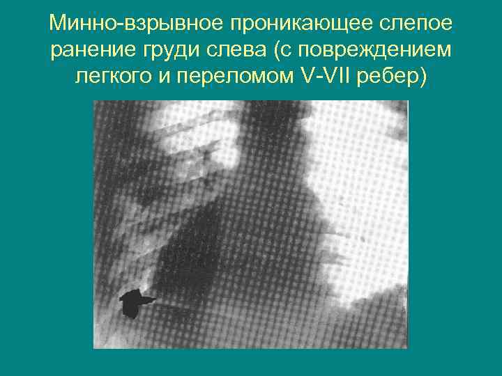 Минно-взрывное проникающее слепое ранение груди слева (с повреждением легкого и переломом V-VII ребер) 