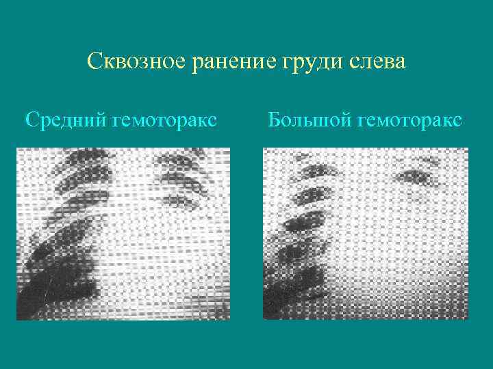 Сквозное ранение груди слева Средний гемоторакс Большой гемоторакс 