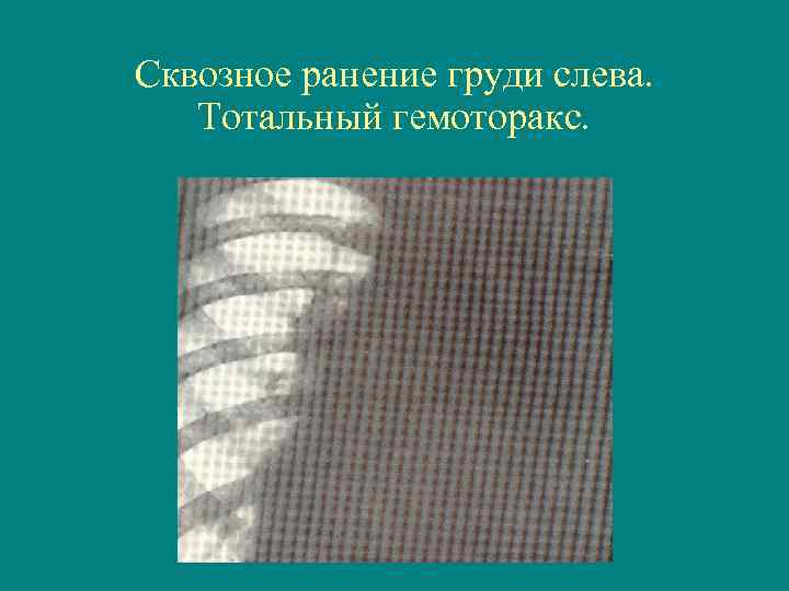 Сквозное ранение груди слева. Тотальный гемоторакс. 