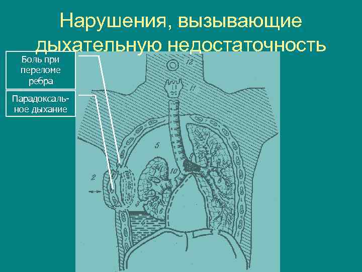 Нарушения, вызывающие дыхательную недостаточность Боль при переломе ребра Парадоксальное дыхание 