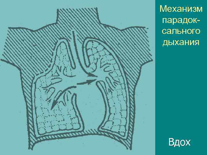 Механизм парадоксального дыхания Вдох 