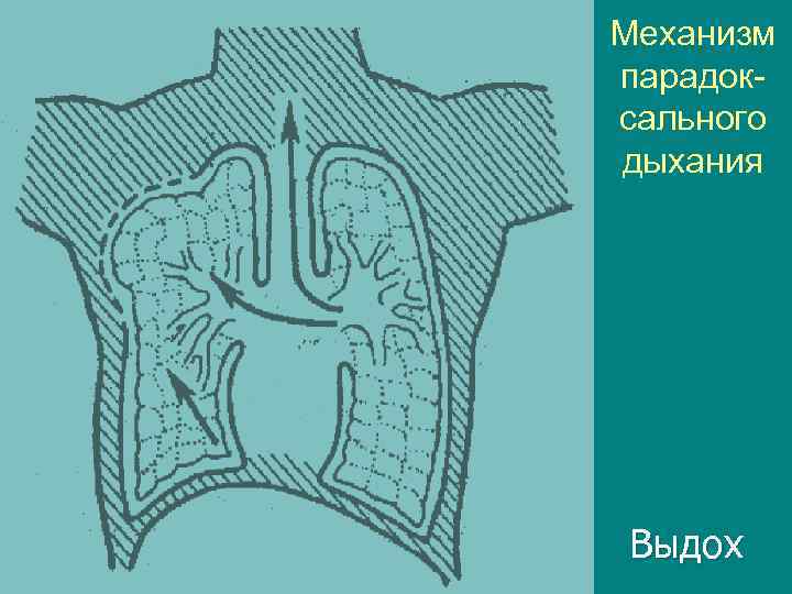 Механизм парадоксального дыхания Выдох 