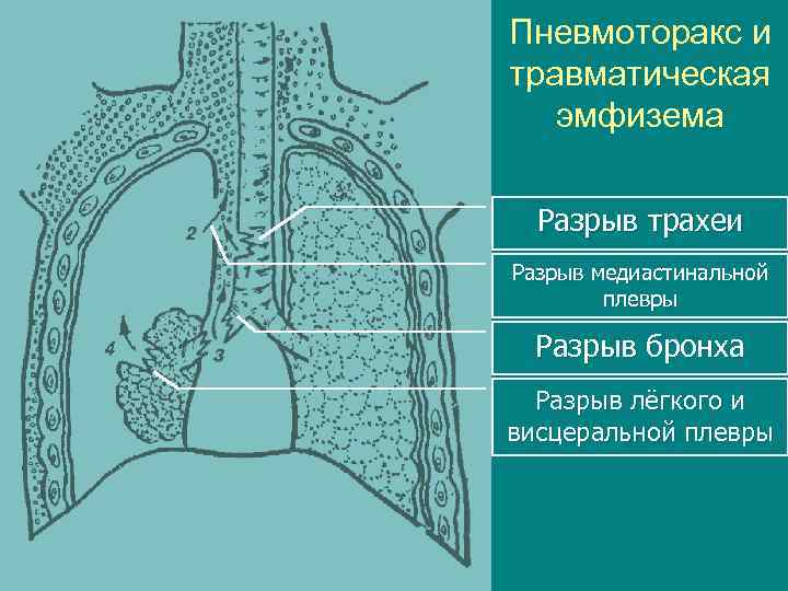 Пневмоторакс и травматическая эмфизема Разрыв трахеи Разрыв медиастинальной плевры Разрыв бронха Разрыв лёгкого и