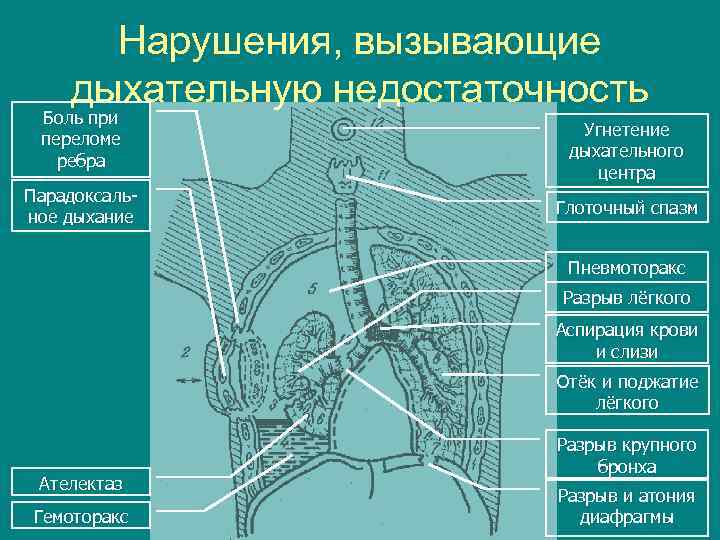 Нарушения, вызывающие дыхательную недостаточность Боль при переломе ребра Парадоксальное дыхание Угнетение дыхательного центра Глоточный