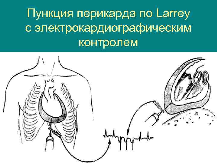 Пункция перикарда по Larrey с электрокардиографическим контролем 