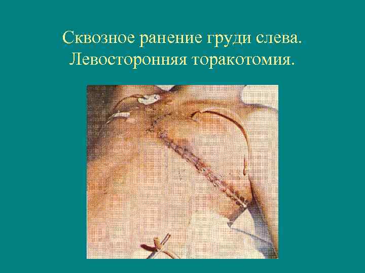 Сквозное ранение груди слева. Левосторонняя торакотомия. 