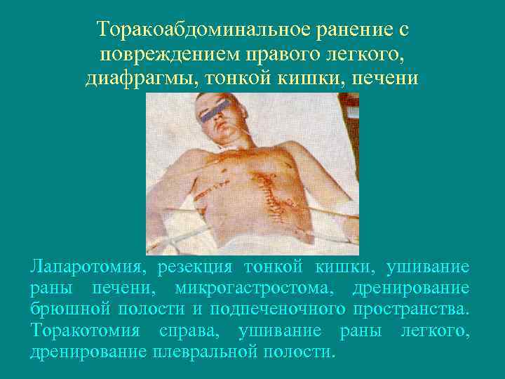 Торакоабдоминальное ранение с повреждением правого легкого, диафрагмы, тонкой кишки, печени Лапаротомия, резекция тонкой кишки,