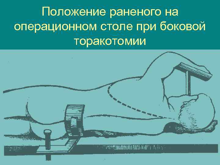 Положение раненого на операционном столе при боковой торакотомии 