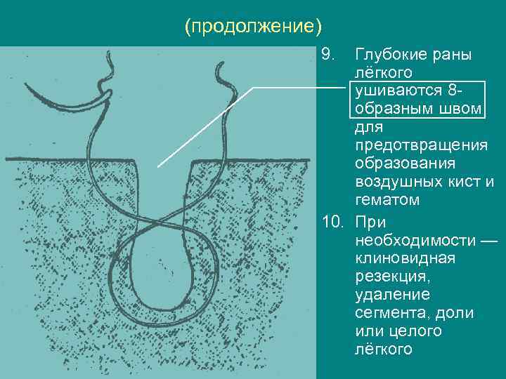 (продолжение) 9. Глубокие раны лёгкого ушиваются 8 образным швом для предотвращения образования воздушных кист