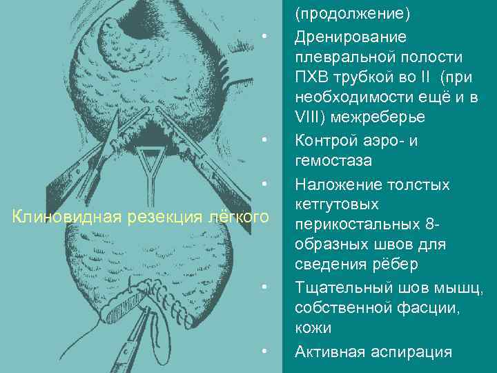  • • • Клиновидная резекция лёгкого • • (продолжение) Дренирование плевральной полости ПХВ