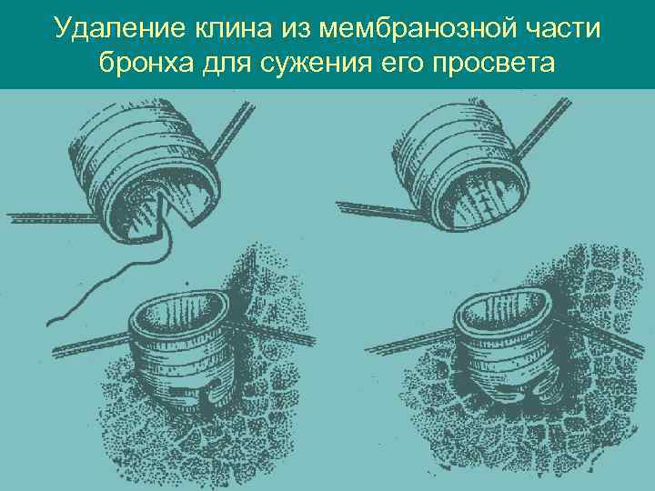 Удаление клина из мембранозной части бронха для сужения его просвета 
