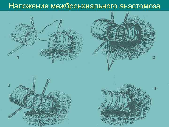 Наложение межбронхиального анастомоза 
