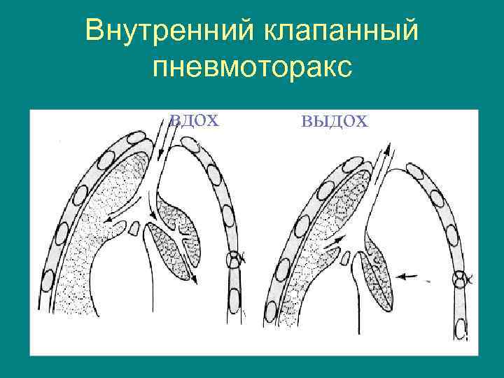 Клапанный пневмоторакс