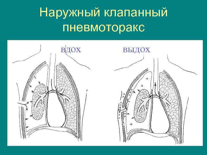 Клапанный пневмоторакс