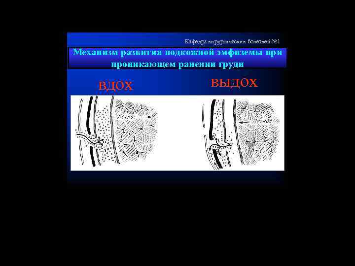 Кафедра хирургических болезней № 1 Механизм развития подкожной эмфиземы при проникающем ранении груди вдох