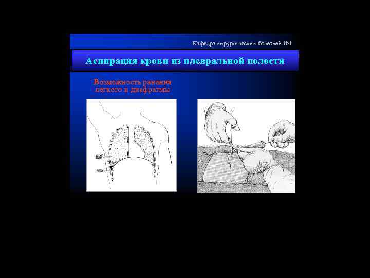 Кафедра хирургических болезней № 1 Аспирация крови из плевральной полости Возможность ранения легкого и