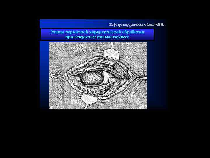 Кафедра хирургических болезней № 1 Этапы первичной хирургической обработки при открытом пневмотораксе 