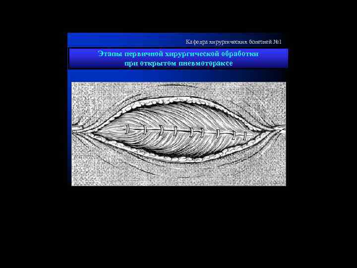 Кафедра хирургических болезней № 1 Этапы первичной хирургической обработки при открытом пневмотораксе 