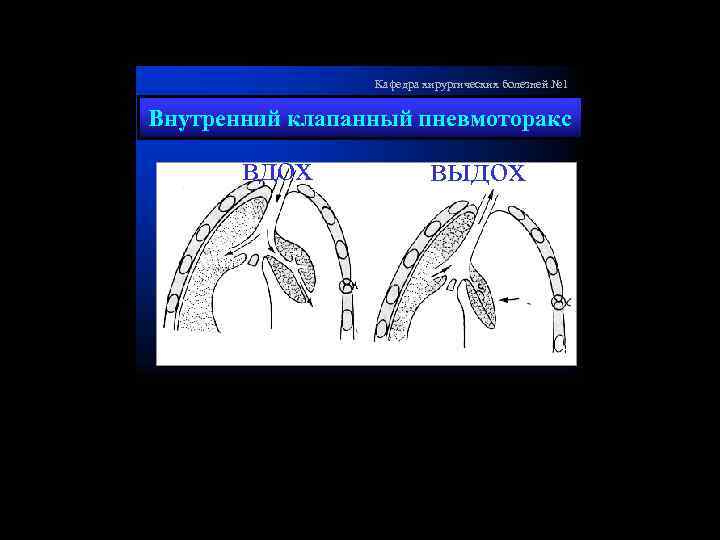 Кафедра хирургических болезней № 1 Внутренний клапанный пневмоторакс вдох выдох 