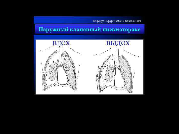 Кафедра хирургических болезней № 1 Наружный клананный пневмоторакс вдох выдох 