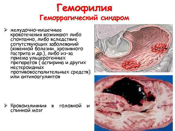  Гемофилия Геморрагический синдром Ø желудочно-кишечные кровотечения возникают либо спонтанно, либо вследствие сопутствующих заболеваний