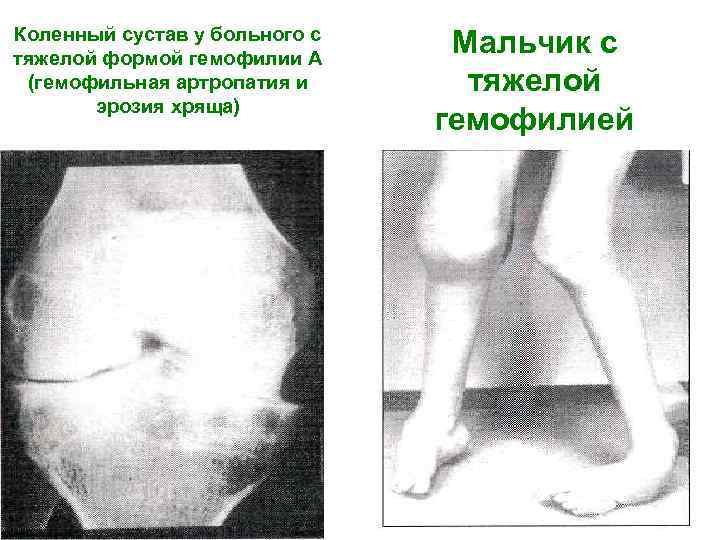 Коленный сустав у больного с тяжелой формой гемофилии А Мальчик с (гемофильная артропатия и