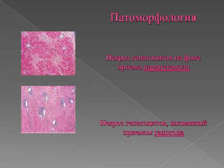 Патоморфология Некроз гепатоцитов на фоне приема парацетамола Некроз гепатоцитов, вызванный приемом галотона 