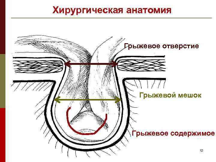 Грыжевой мешок. Грыжевые ворота грыжевой мешок грыжевое содержимое. Грыжевые ворота анатомия грыжи. Анатомия грыжевого мешка.