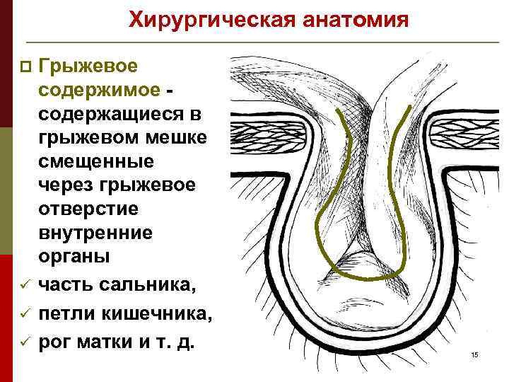 Грыжевые ворота грыжевой мешок