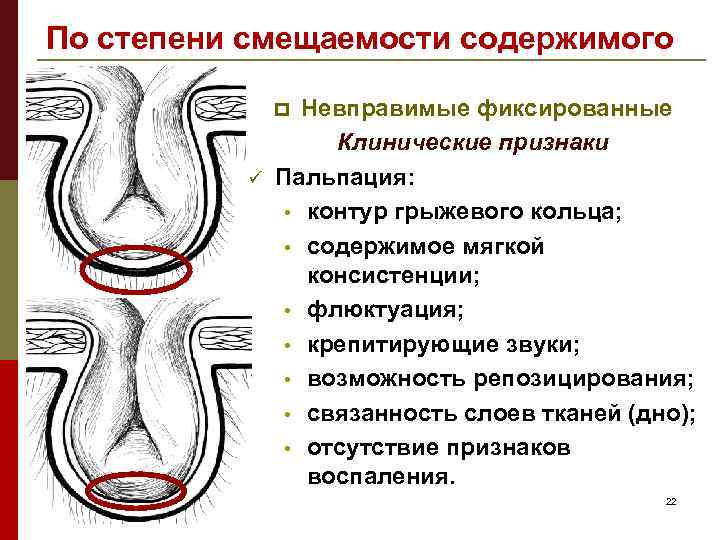 Промежностная грыжа фото