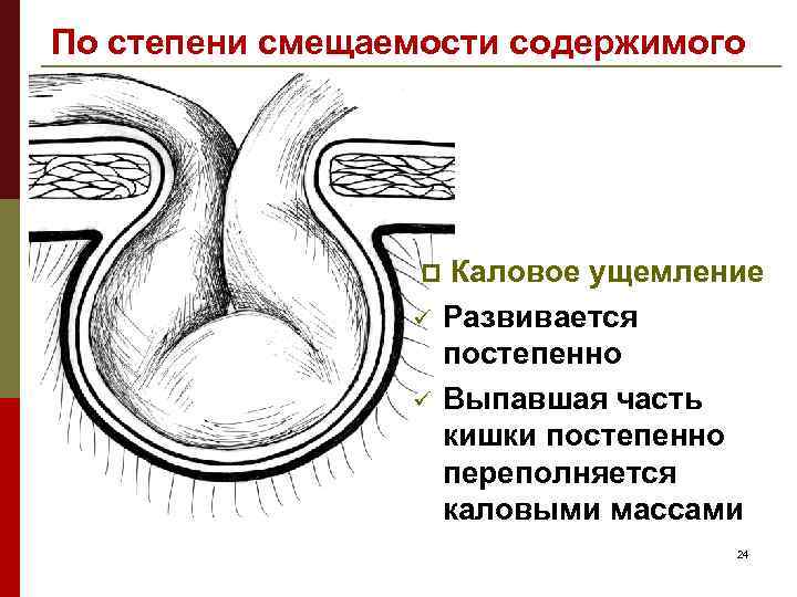По степени смещаемости содержимого p ü ü Каловое ущемление Развивается постепенно Выпавшая часть кишки