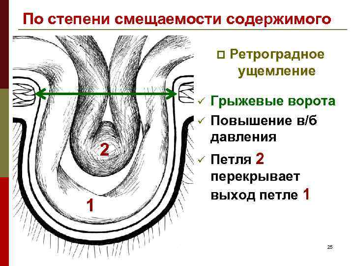 По степени смещаемости содержимого p ü ü 2 1 ü Ретроградное ущемление Грыжевые ворота