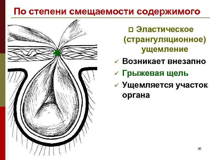 По степени смещаемости содержимого Эластическое (странгуляционное) ущемление Возникает внезапно Грыжевая щель Ущемляется участок органа
