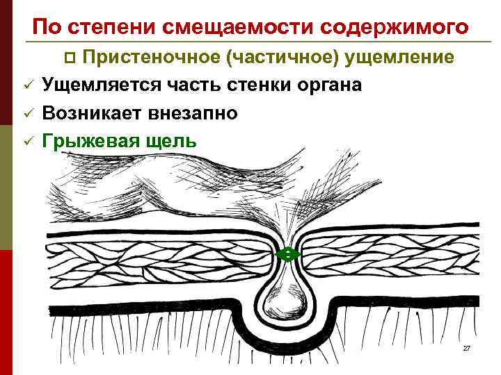 По степени смещаемости содержимого Пристеночное (частичное) ущемление Ущемляется часть стенки органа Возникает внезапно Грыжевая