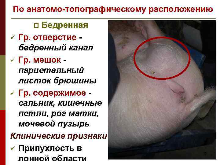 По анатомо-топографическому расположению Бедренная ü Гр. отверстие бедренный канал ü Гр. мешок париетальный листок