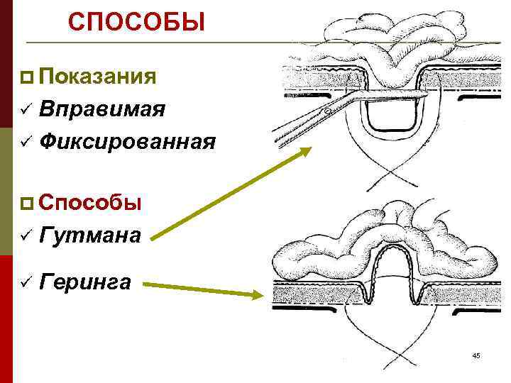 СПОСОБЫ p Показания Вправимая ü Фиксированная ü p Способы ü Гутмана ü Геринга 45