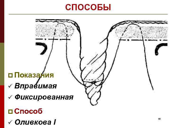 СПОСОБЫ p Показания Вправимая ü Фиксированная ü p Способ ü Оливкова I 46 