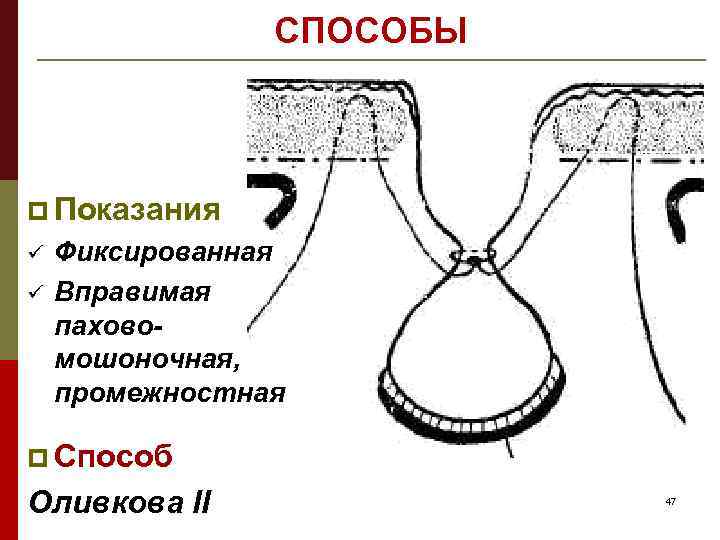 СПОСОБЫ p Показания ü ü Фиксированная Вправимая паховомошоночная, промежностная p Способ Оливкова II 47