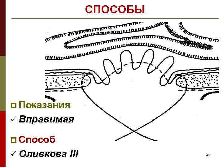 СПОСОБЫ p Показания ü Вправимая p Способ ü Оливкова III 48 