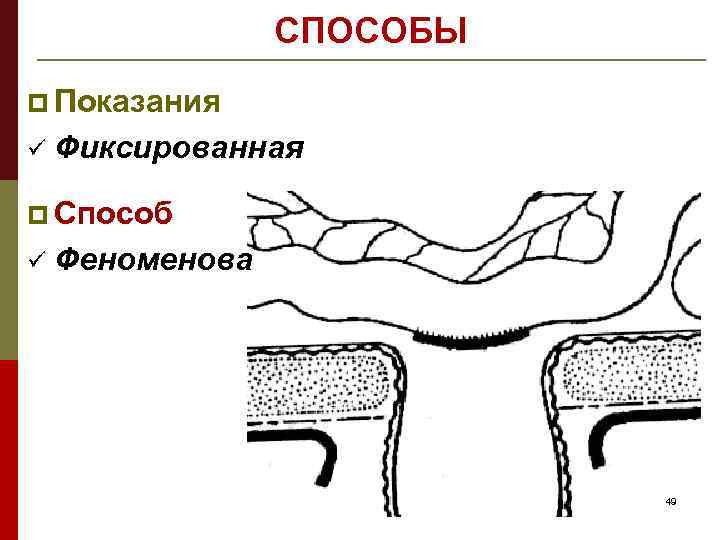 СПОСОБЫ p Показания ü Фиксированная p Способ ü Феноменова 49 