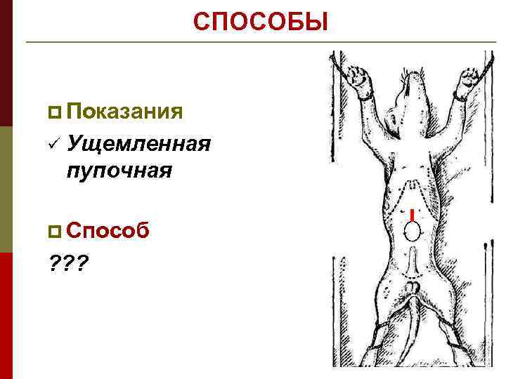 СПОСОБЫ p Показания ü Ущемленная пупочная p Способ ? ? ? 50 