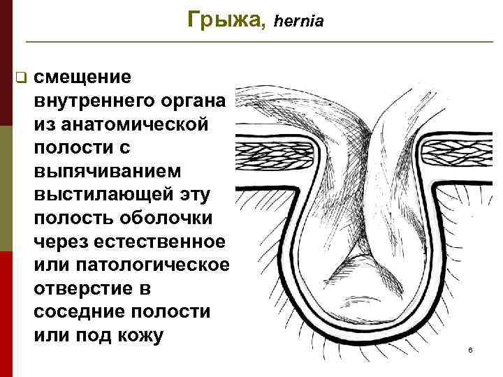 Грыжа, hernia q смещение внутреннего органа из анатомической полости с выпячиванием выстилающей эту полость