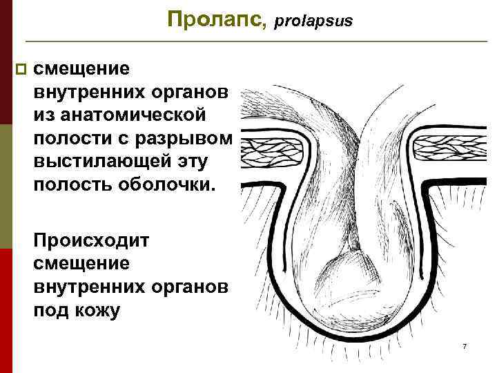 Пролапс, prolapsus p смещение внутренних органов из анатомической полости с разрывом выстилающей эту полость