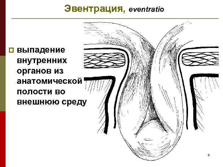 Эвентрация, eventratio p выпадение внутренних органов из анатомической полости во внешнюю среду 8 