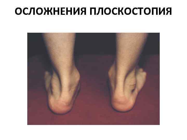 ОСЛОЖНЕНИЯ ПЛОСКОСТОПИЯ 